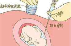脐带血穿刺,产前诊断的关键技术与风险解析